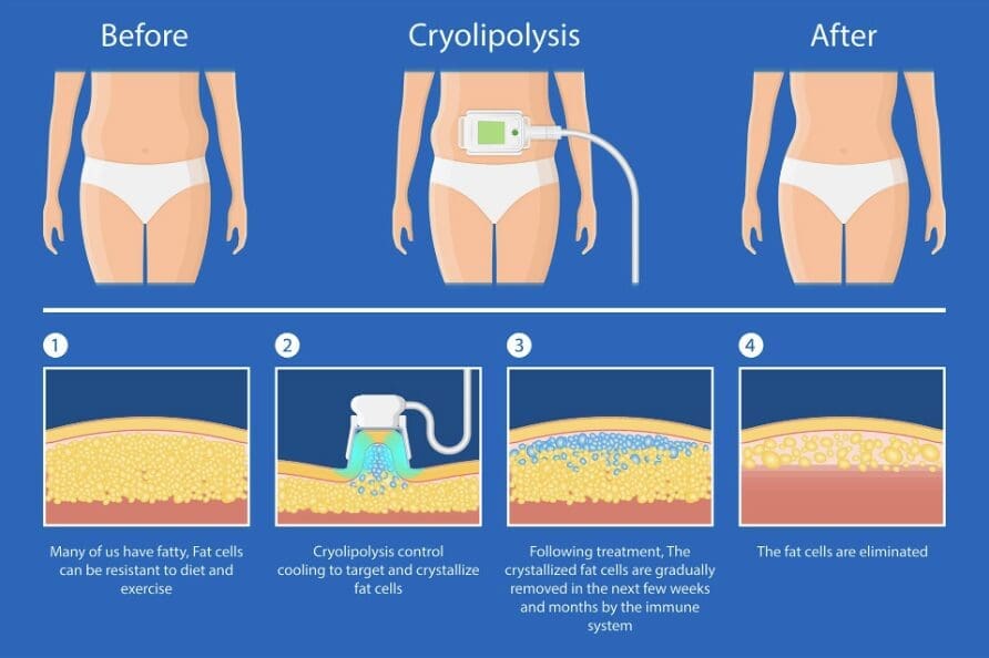 علاج تجميد أو تحلل الدهون بالتبريد