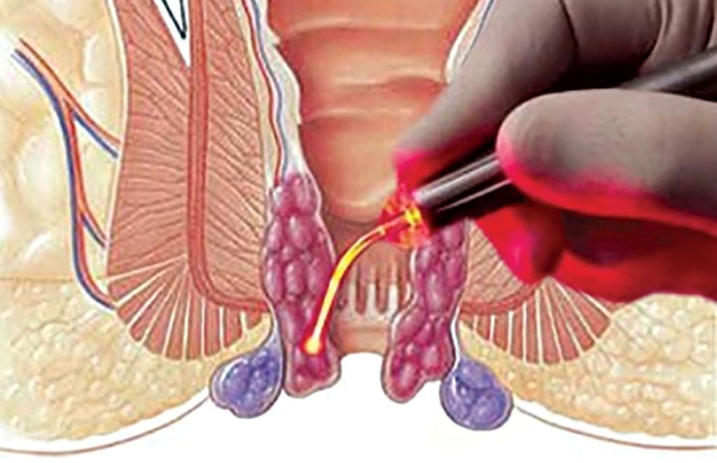 عملية البواسير بالليزر