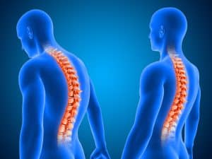 علاج اعوجاج العمود الفقري