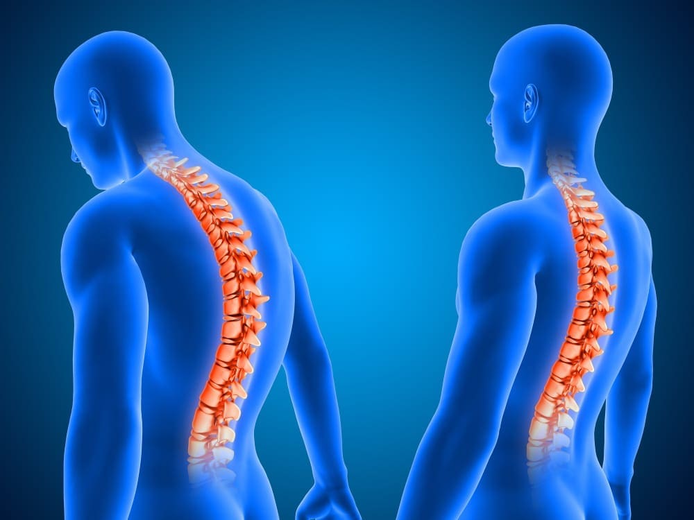 علاج اعوجاج العمود الفقري