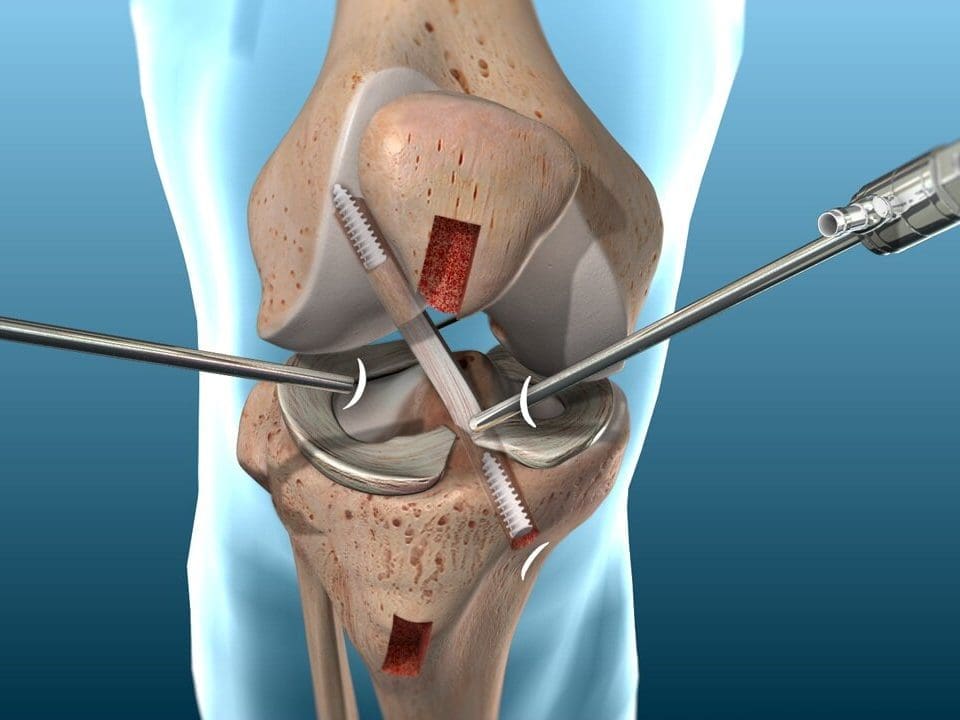 جراحة إصلاح أربطة الركبة