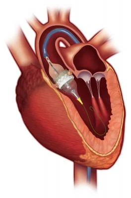 استبدال الصمام الأبهري عبر القسطرة TAVR | TAVI