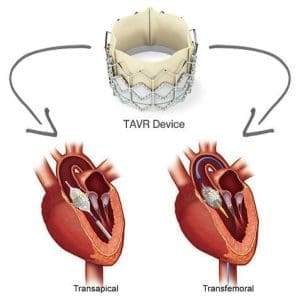 استبدال الصمام الأبهري عبر القسطرة TAVR | TAVI