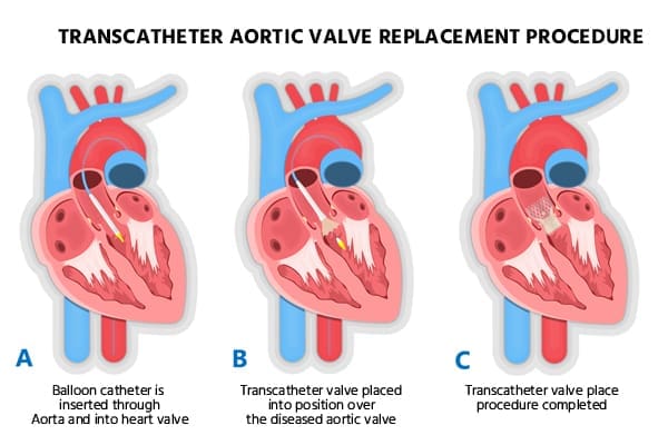 استبدال الصمام الأبهري عبر القسطرة TAVR | TAVI