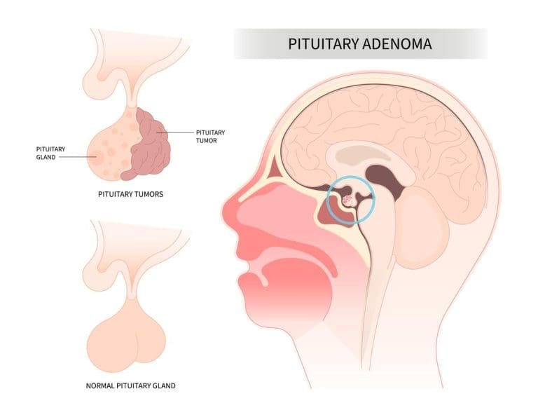 أورام الغدة النخامية