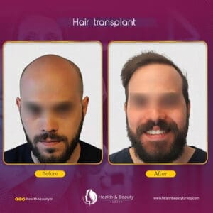 زراعة الشعر في تركيا