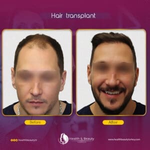 زراعة الشعر في تركيا اسطنبول