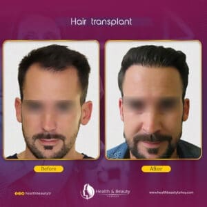 أفضل مشفى زراعة شعر