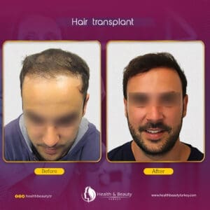 زراعة الشعر في تركيا