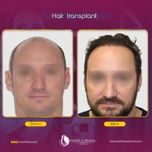 افضل دكتور زراعة شعر