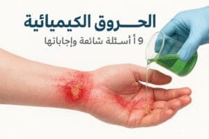 الحروق الكيميائية